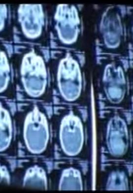 精神分裂症 Schizophrenia: Stolen Minds, Stolen Lives
